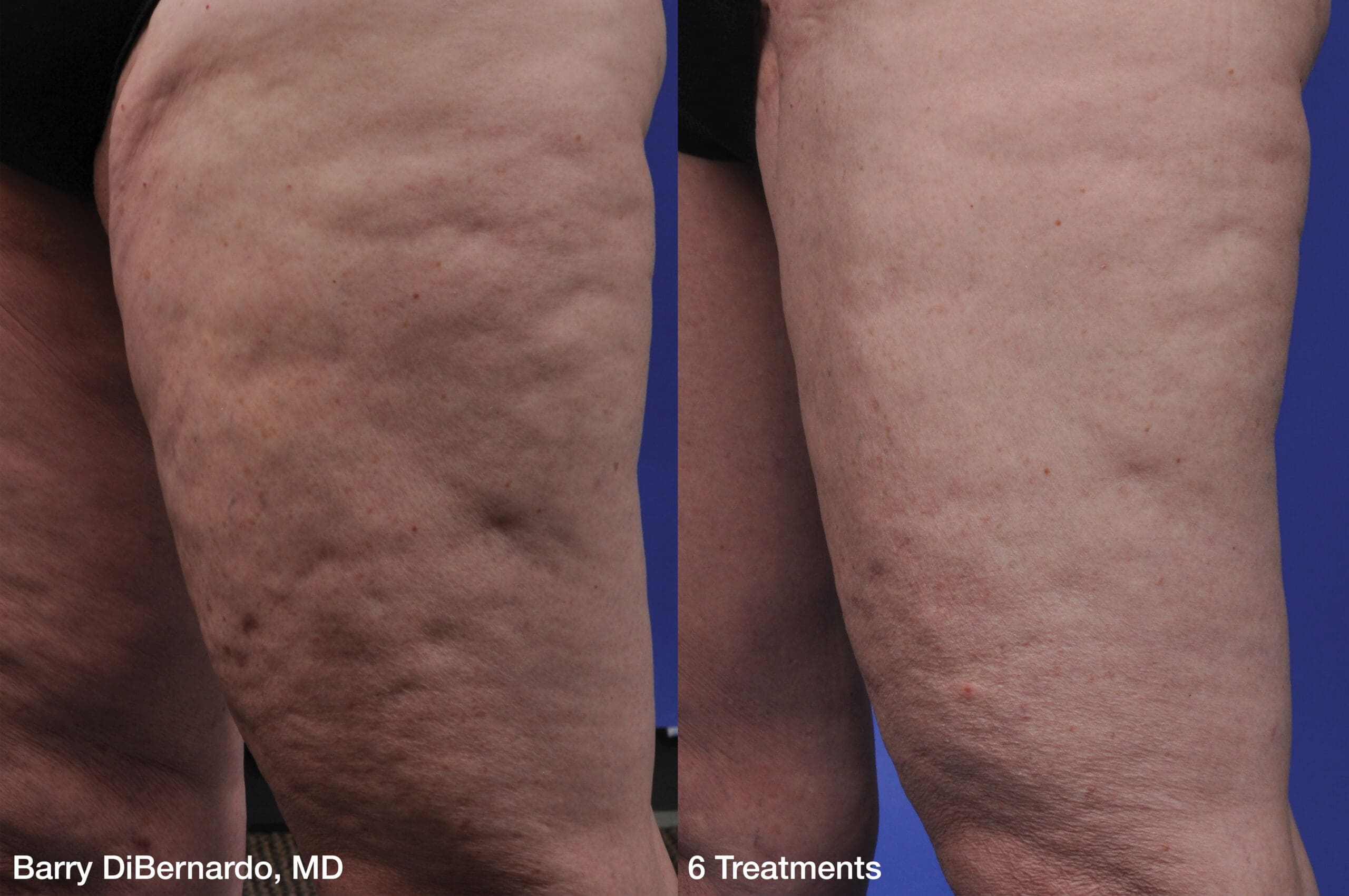 ThermiSmooth before-and-after result following six treatments