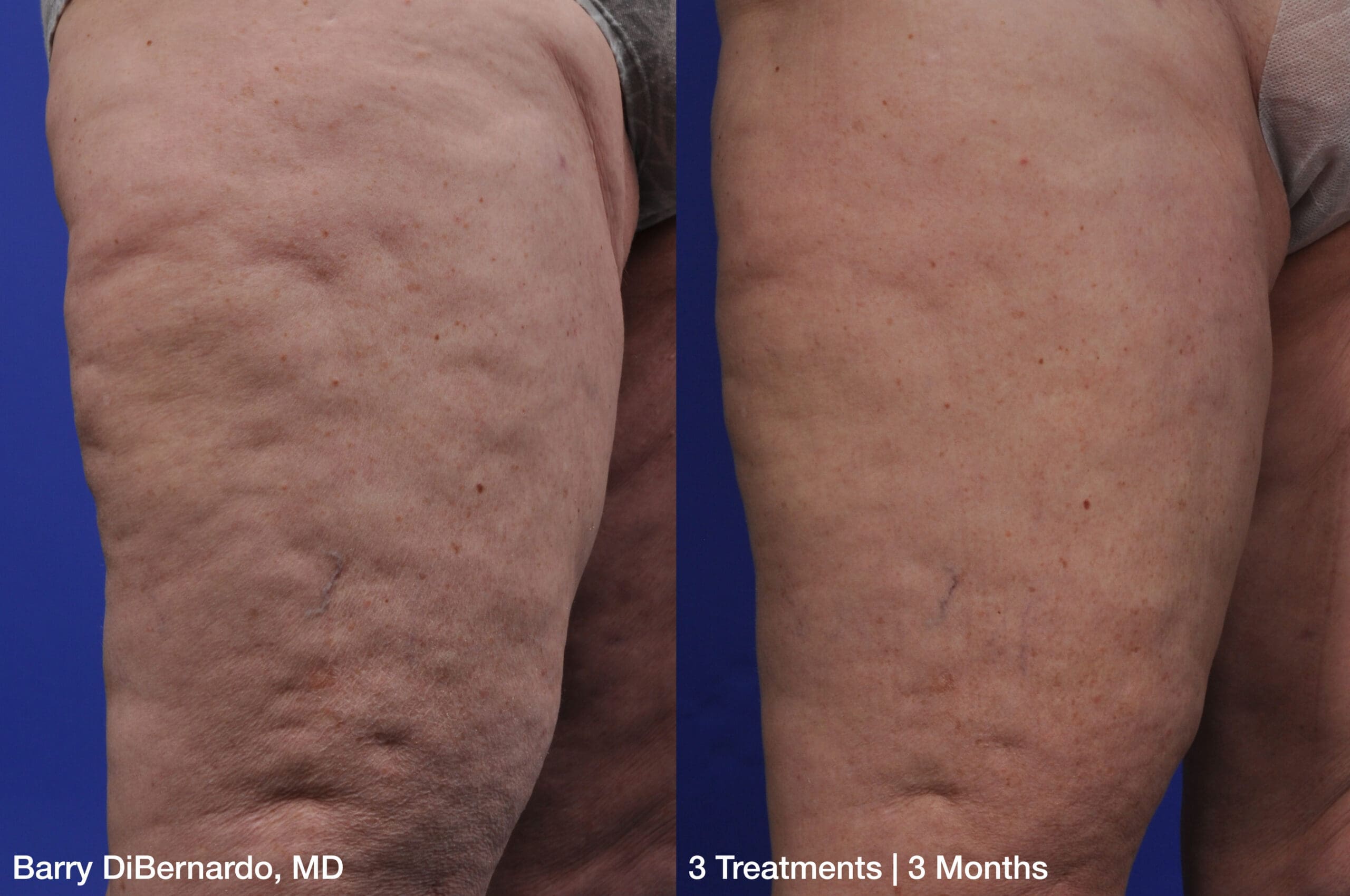 ThermiSmooth before-and-after result following three treatments at three months